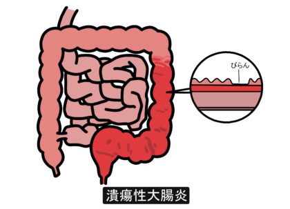 潰瘍性大腸炎