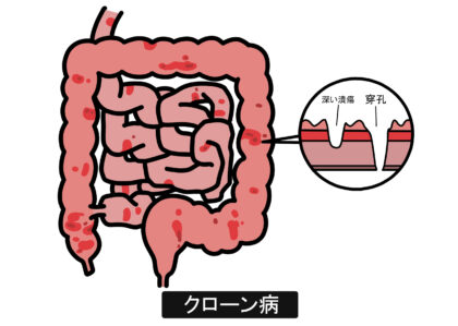 クローン病